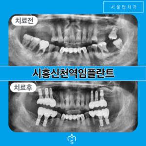 서울탑치과 임플란트