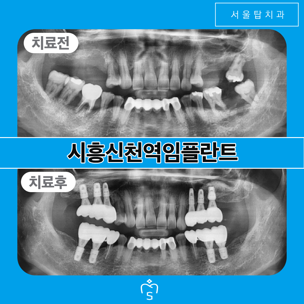 서울탑치과 임플란트
