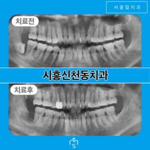서울탑치과 사랑니발치