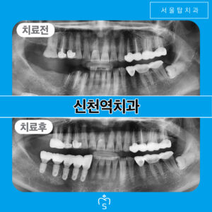 서울탑치과 임플란트