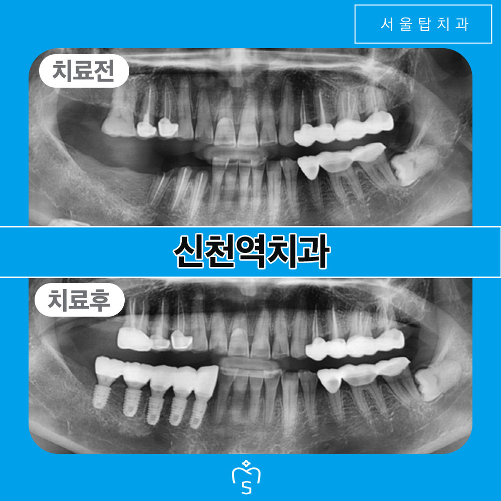 서울탑치과 임플란트