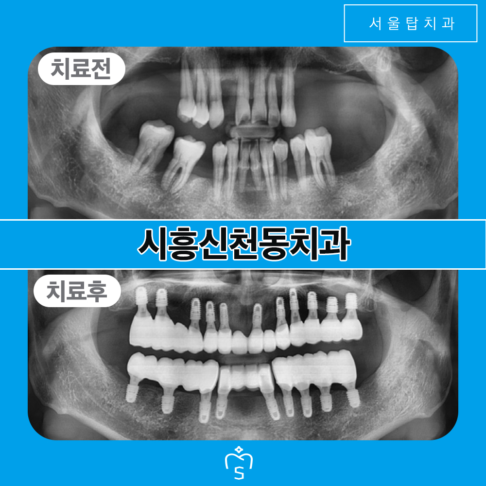 서울탑치과 임플란트