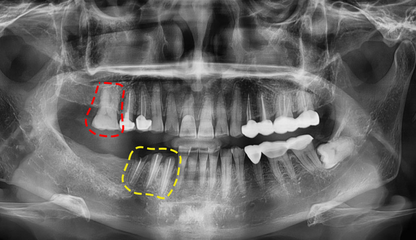 서울탑치과 임플란트