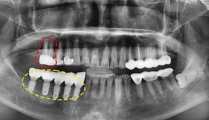 서울탑치과 임플란트