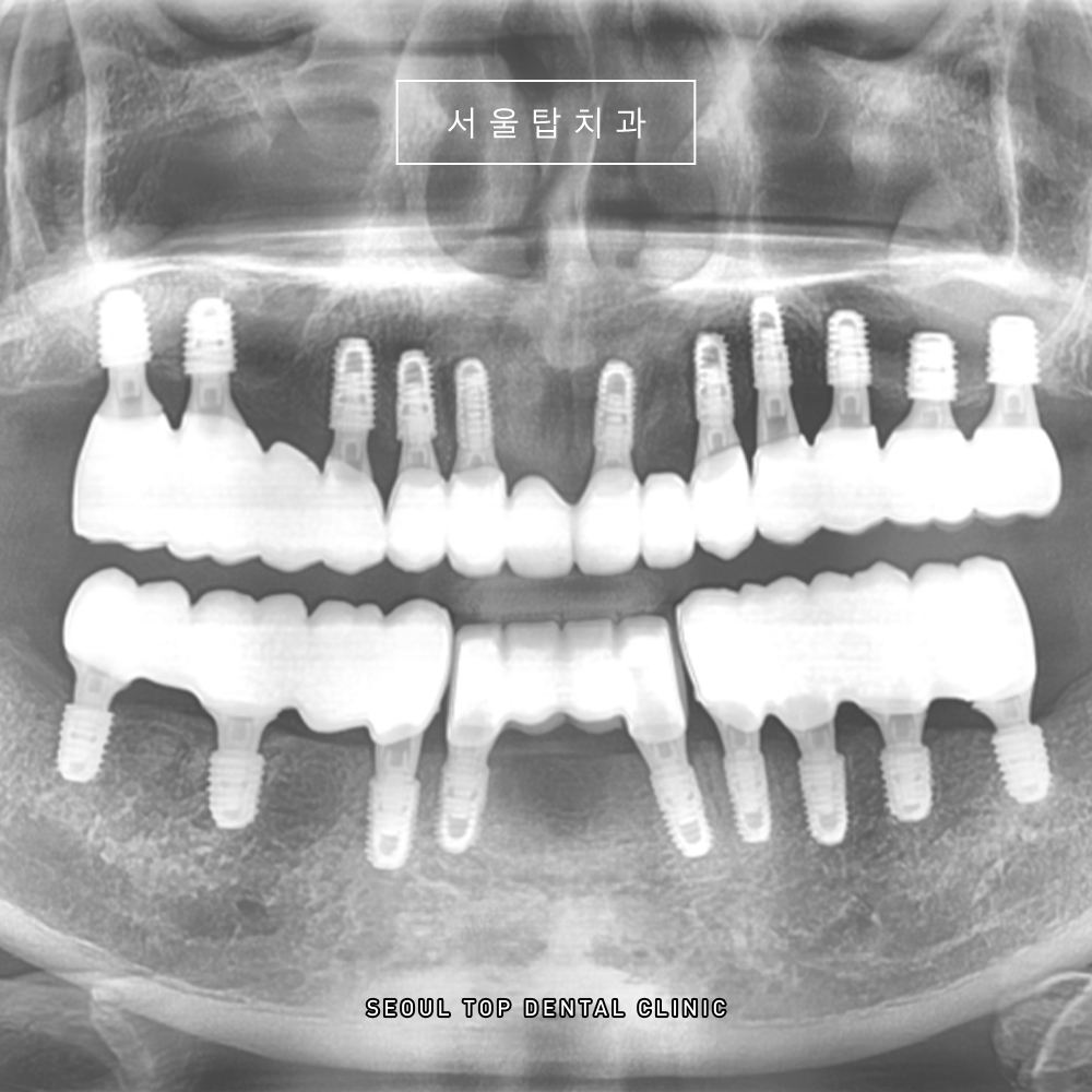 서울탑치과 임플란트