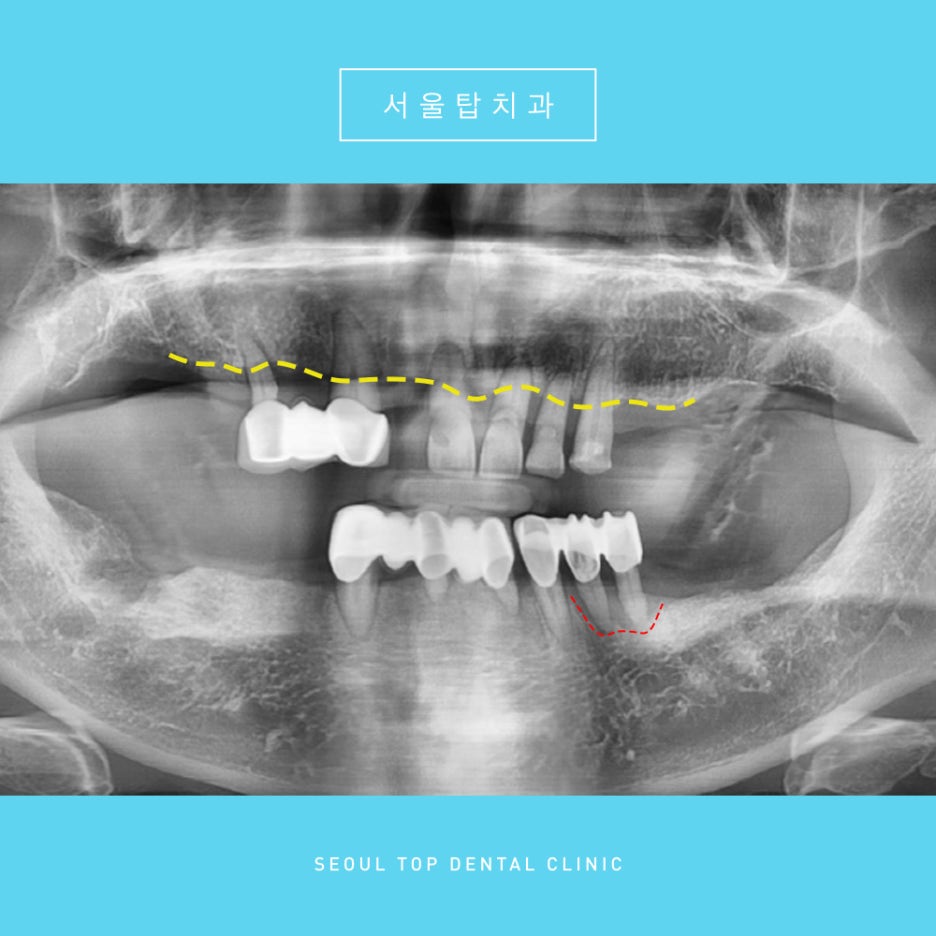 서울탑치과 임플란트