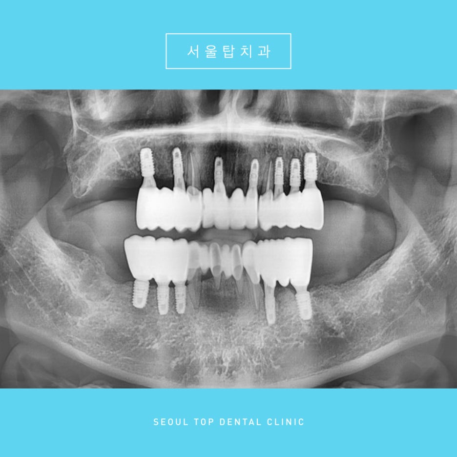 서울탑치과 임플란트