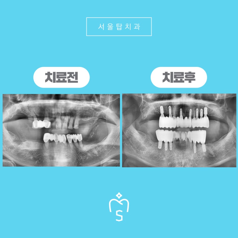 서울탑치과 임플란트