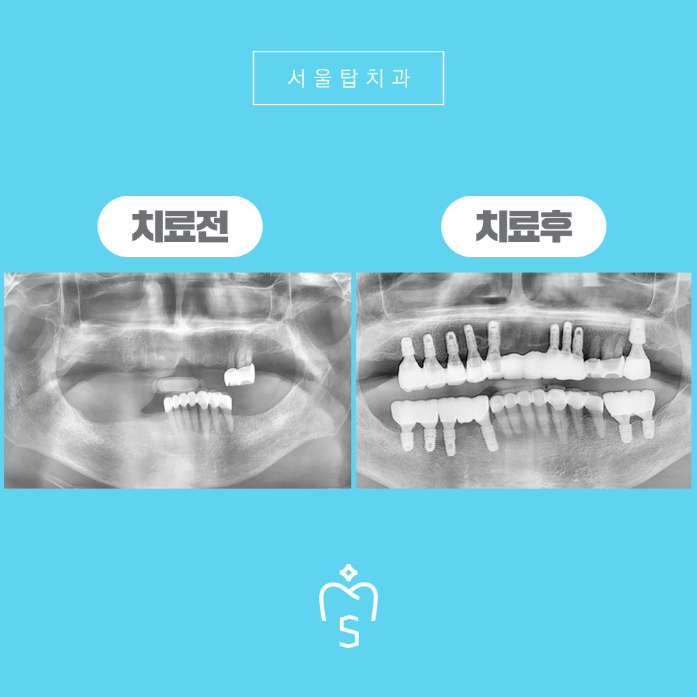 서울탑치과 치료전후