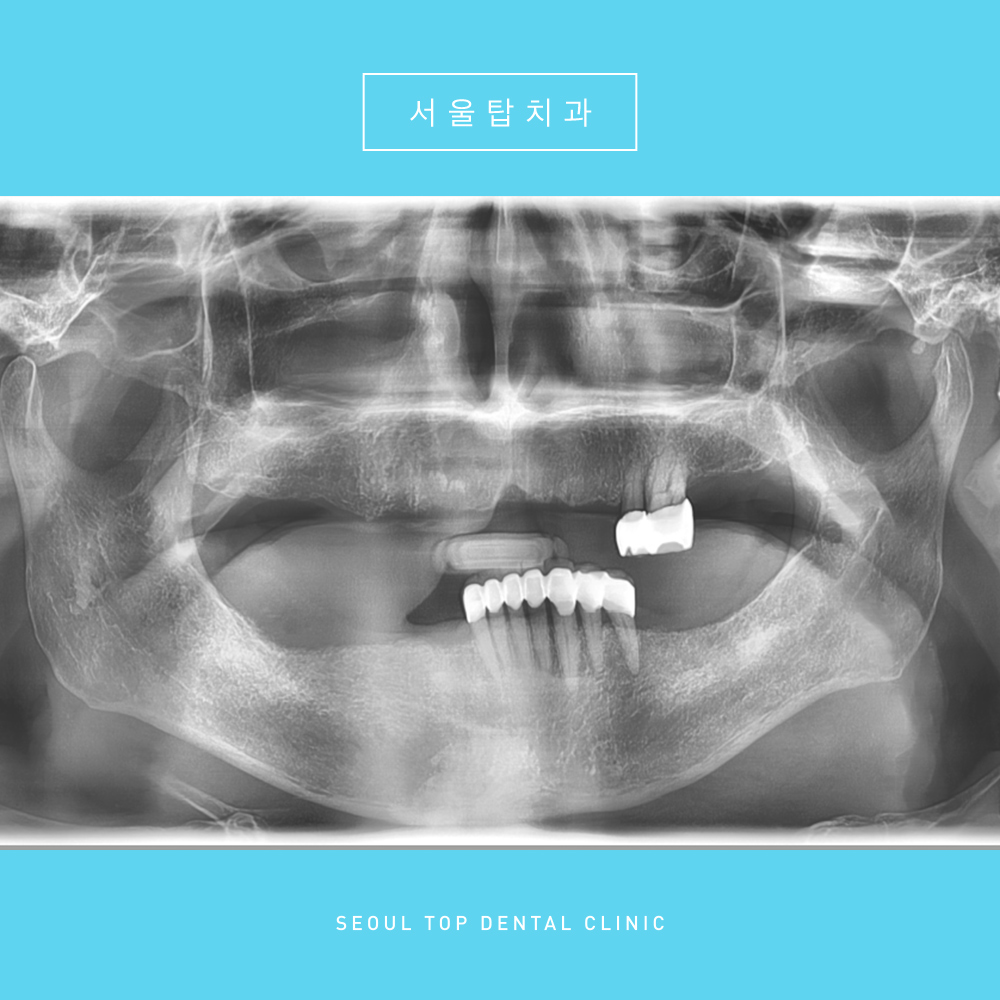 서울탑치과 치료 전