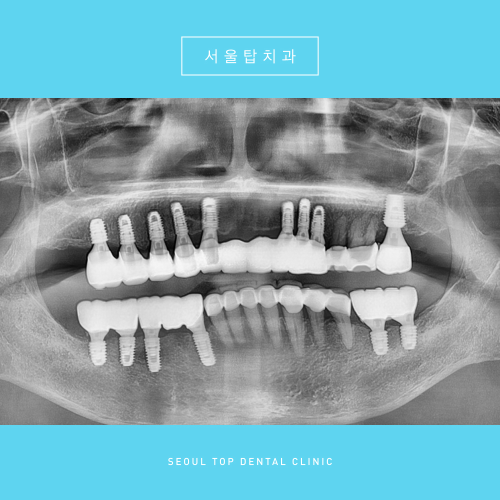 서울탑치과 치료 후
