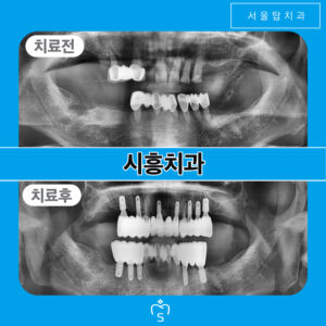 서울탑치과 임플란트