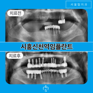 시흥신천역임플란트-서울탑치과