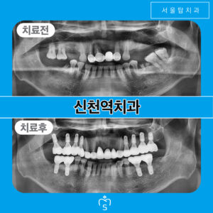서울탑치과-증례첫표지